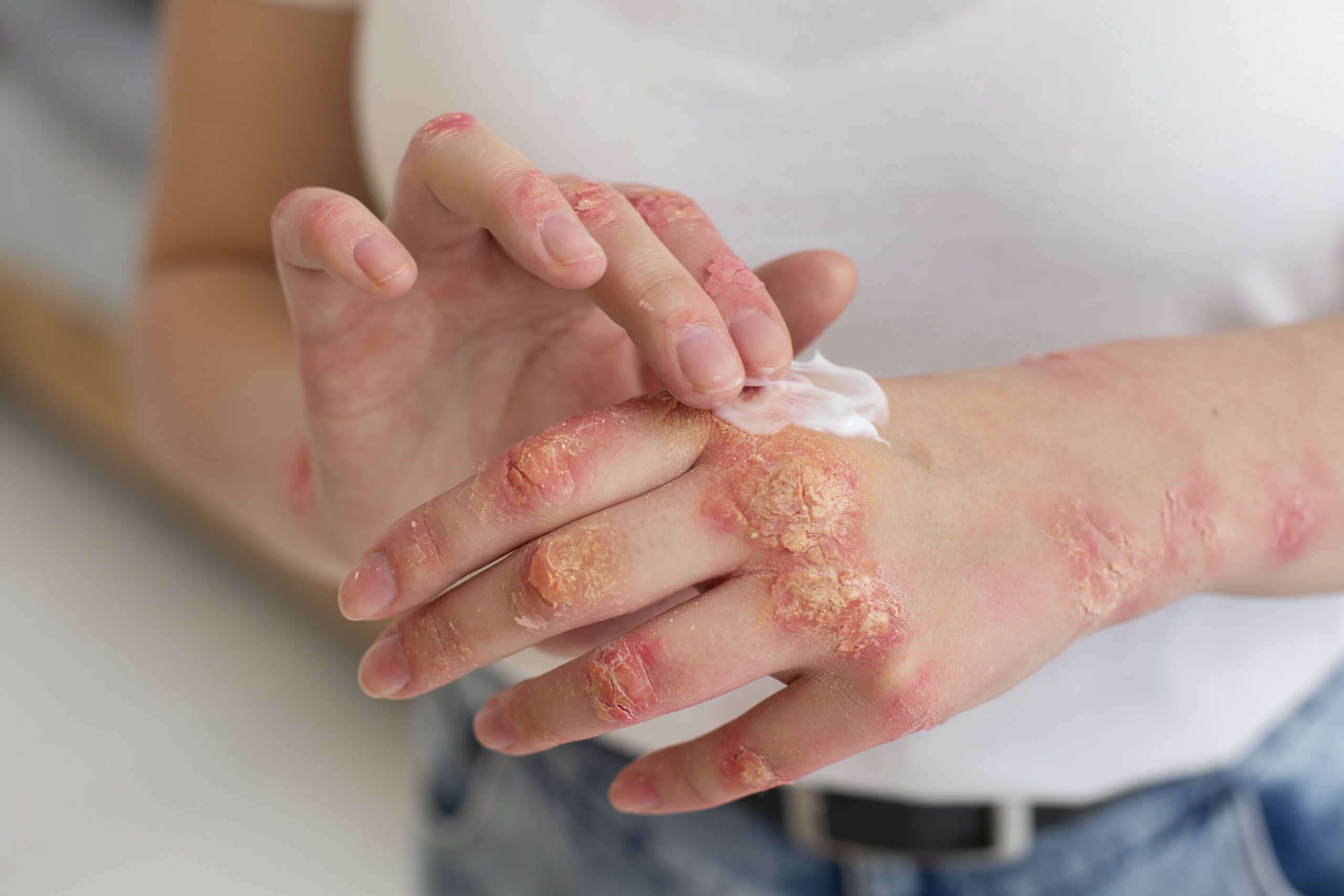 Aceites Esenciales para el Bienestar de la Piel con Psoriasis: Protocolo de Apoyo Bio-Dérmico y Cuidado Profundo