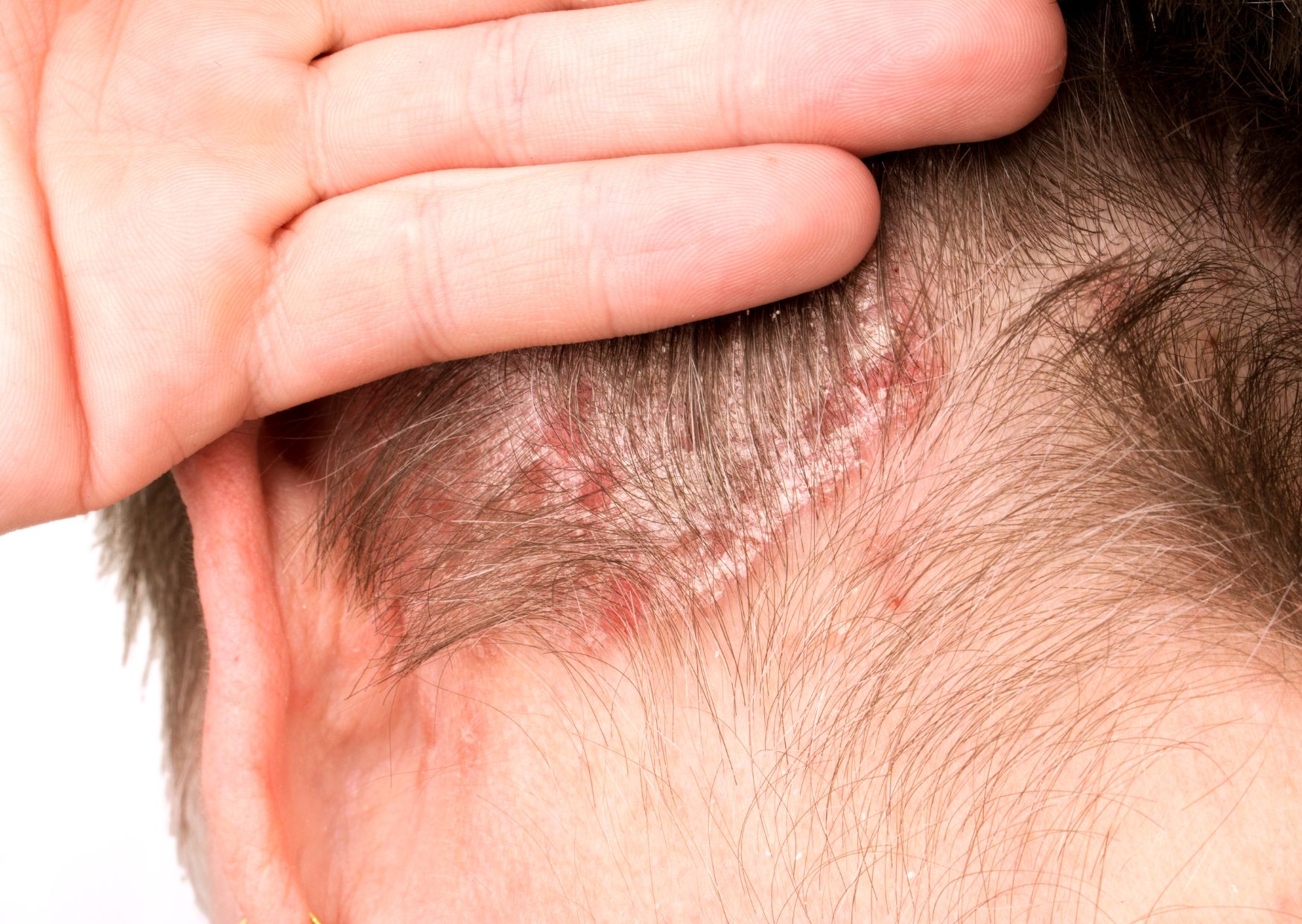 Aceites Esenciales para la Dermatitis Seborreica: Protocolo de Modulación del Microbioma Cutáneo y Control de la Inflamación
